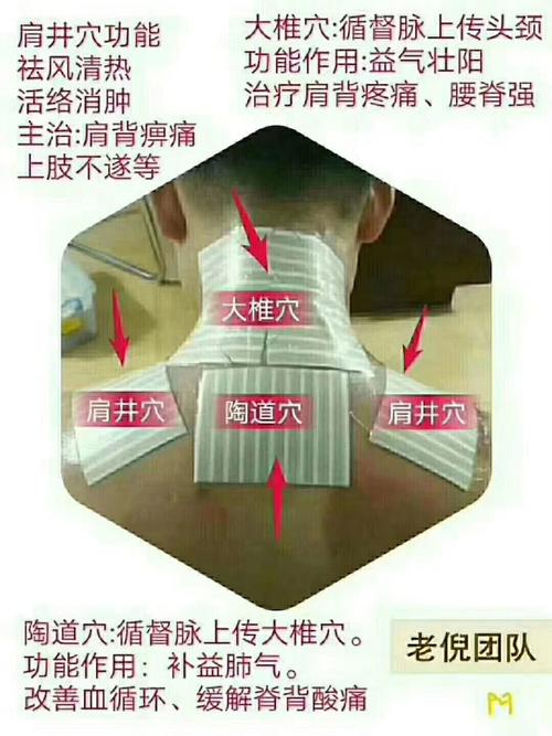 中医药膏穴位加贴痛点