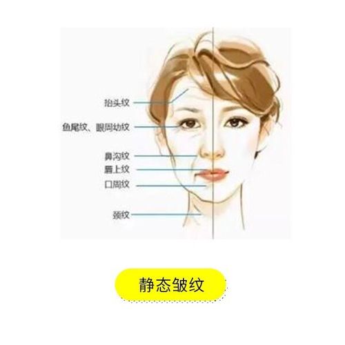 面部皱纹都有哪些种类?形成原因?如何除皱?