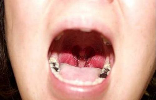 扁桃体炎术后图片 扁桃体炎扁桃体肿大图片