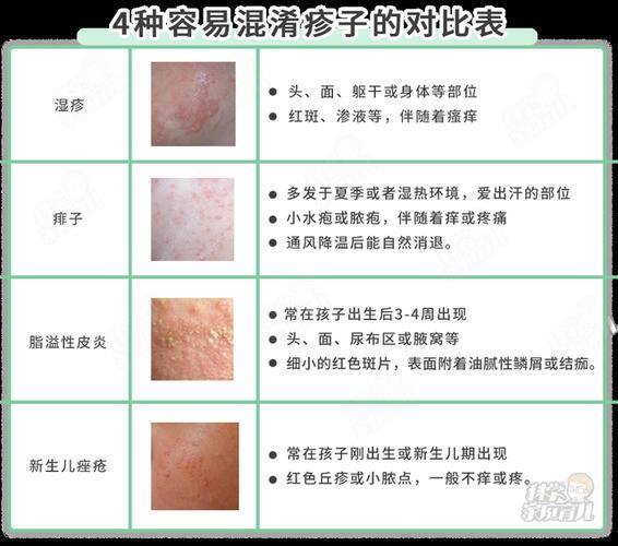 宝宝湿疹总反复怎么办?60%湿疹,不要用药!