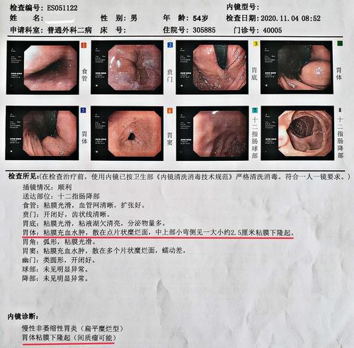 周一"胃小弯侧间质瘤"中年男性患者,54岁,胃镜检查提示:胃小弯侧间质