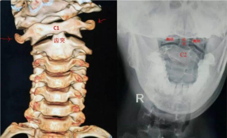 儿童寰枢关节半脱位的诊治