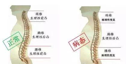 椎间盘突出是什么原因造成的?|椎骨|膨出|髓核|脊椎骨_网易订阅