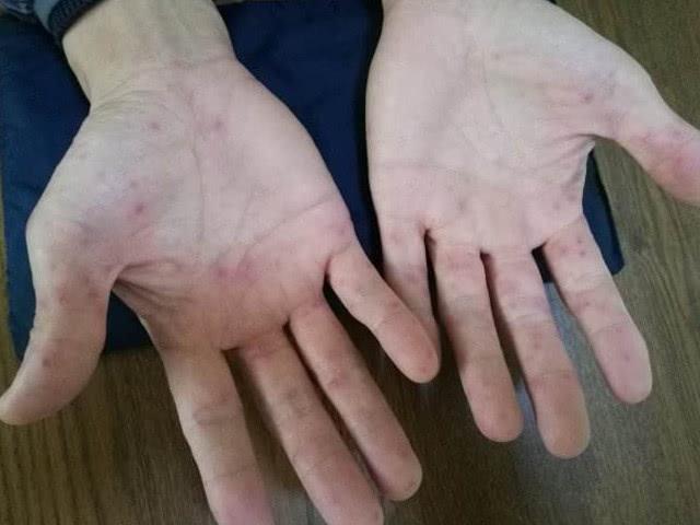 偷欢一次感染艾滋病?不论男女,观察皮肤有没有这3种"迹象"