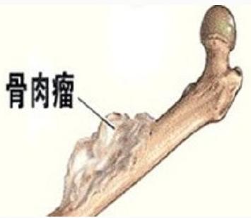 骨肉瘤的多种诊断方法