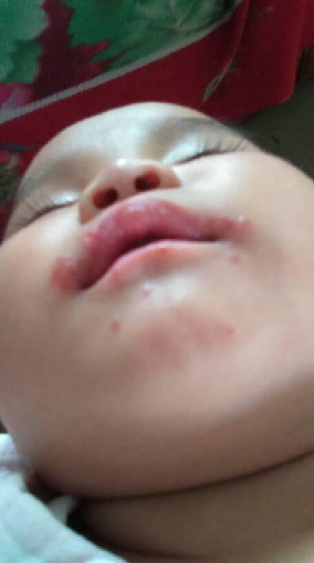 儿子嘴上长黄浓疮了怎么办