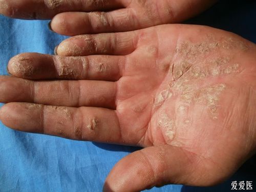角化性湿疹 - 皮肤及性传播疾病讨论版 - 爱爱医医学
