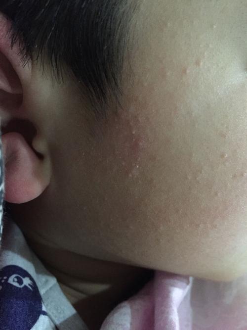 宝宝脸上长这些小颗粒有没有办法治好?从小生出来皮肤