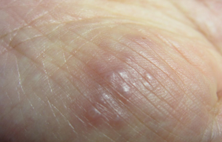 疥疮的症状表现