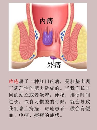 痔疮形成的原因_痔疮_医疗健康_医疗健康其他