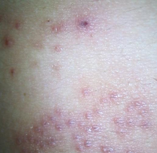 请问这是湿疹还是疥疮还是疱疹,或者别的?