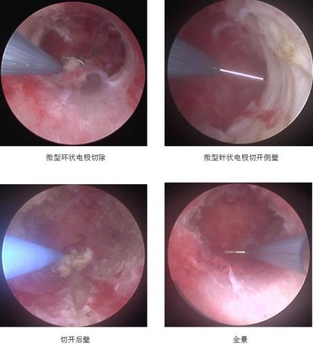 病例报告 | t型子宫畸形的微型宫腔镜诊治技巧