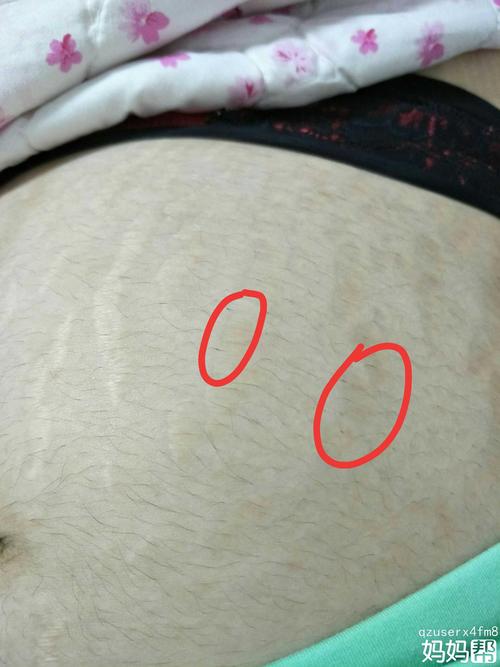 肚子长毛怎么回事