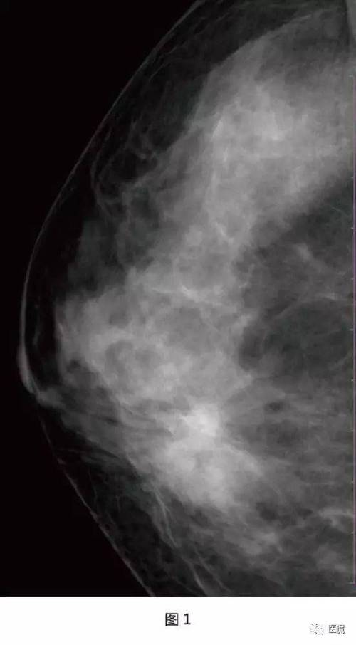 采用 ge senographe ds数字乳腺x线机,患者取立位,常规头尾位,内外斜