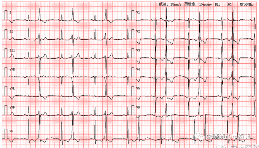 每日读图|第1282期 室早二联律