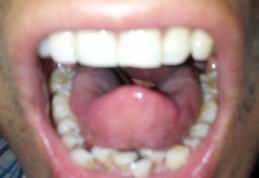 关于咽喉的问题,我能看到自己的会厌,是怎么回事呀?