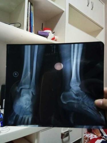 脚踝骨折有ct片请各位给点建议