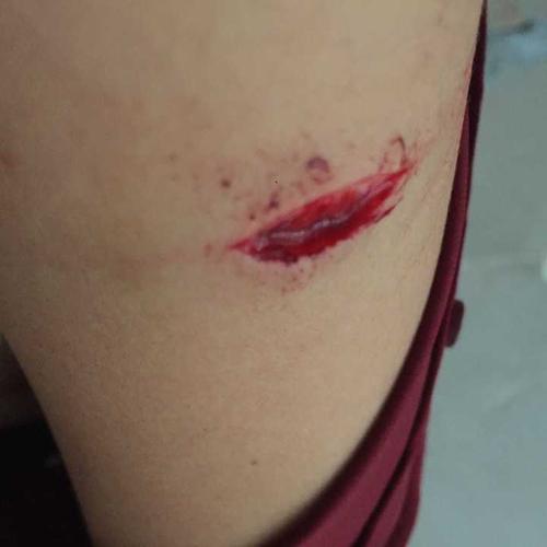 迄今为止,你感到(生理上)最痛的一次经历是什么?