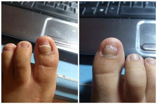 指甲淤血与甲床分离,剪掉之后还能长出来吗?