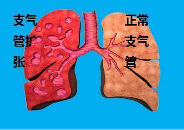 年轻人也会患上肺气肿吗?