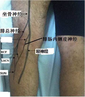 体表神经解剖:胫神经