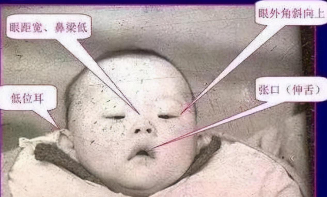 原创为何唐氏儿都长"同一张脸"?并非是巧合,和这些原因有关