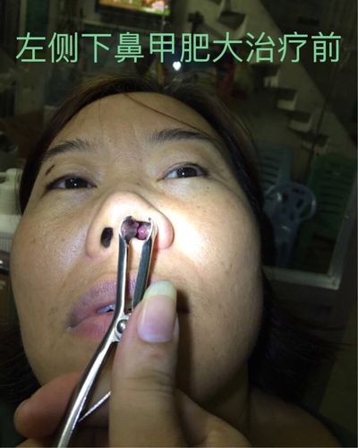 鼻甲肥大疗法;用棉棒一面涂上无痛鼻甲膏,放入下鼻道60分钟,15天一次