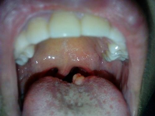 请问舌头上的这个东西是什么,我大约七八岁就有这个东西了,当时只是一