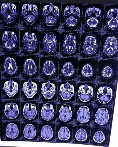 【门诊实录】脑肿瘤导致的继发性三叉神经痛一例