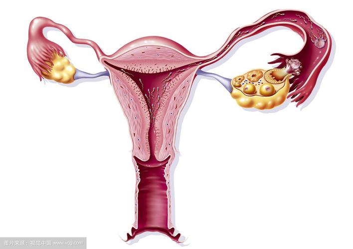 子宫一侧韧带缺如伴输卵管卵巢异位盆侧壁1例