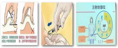 你的"肝素针"打对了吗