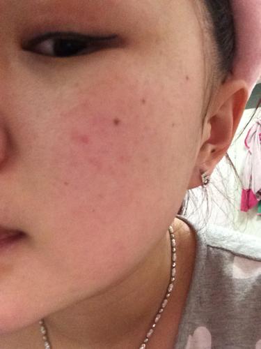 脸上起得小红点,是过敏么?之前用科研式得