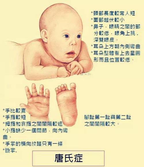 世界唐氏综合征日|收起歧视的目光 用真心拥抱"唐宝宝"