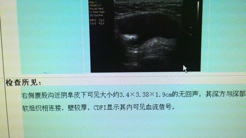 妇科常见的圆韧带囊肿