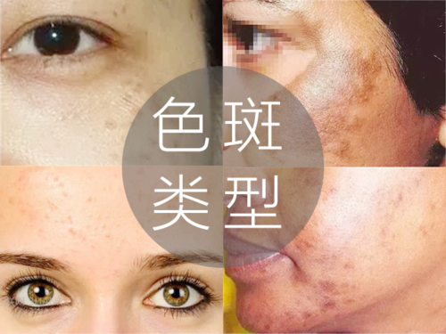 脸上的色斑到底属于什么类型?你知道几种?看图识斑