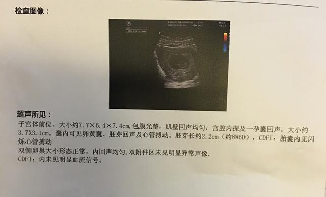 早孕试纸已经测出怀孕,为何还要再验b超?