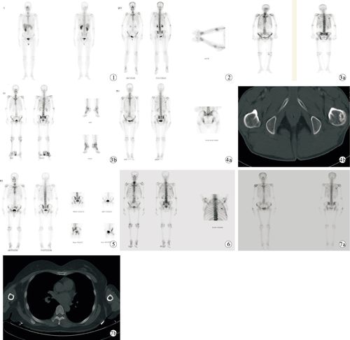 pdca循环改进方法在提高全身骨扫描图像质量中的应用