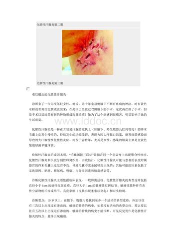难以根治的化脓性汗腺炎.docx