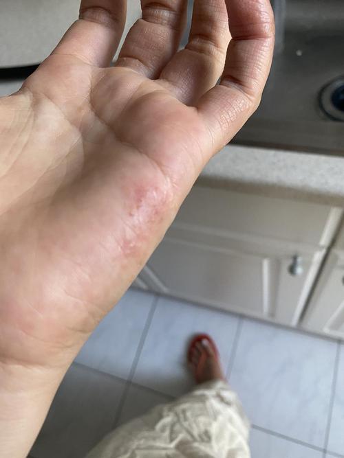多年手上湿疹怎么破.
