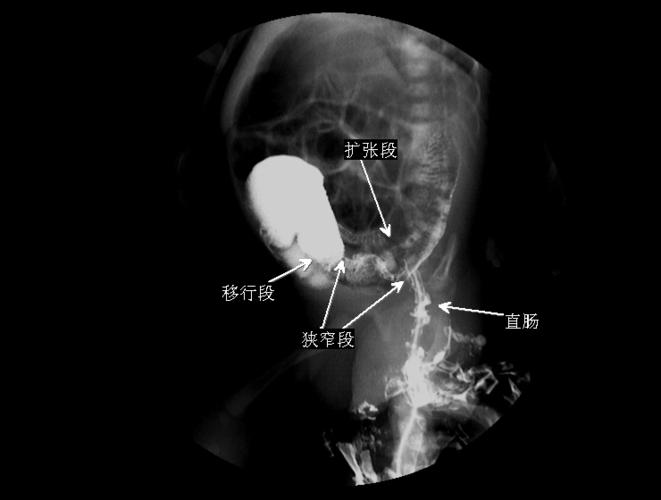 x 线片多可发现肠腔充气扩张或低位肠梗阻,造影显示典型的狭窄段,扩张