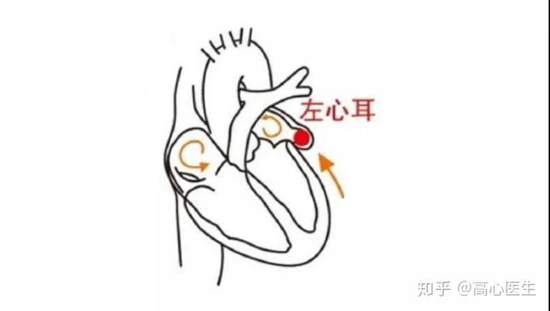 左心耳封堵怎么做?