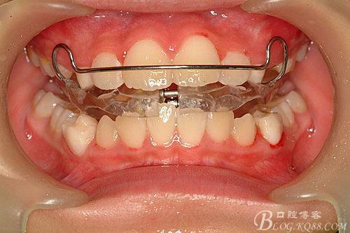 1)activator(肌激动器):1908 年由andresen设计,又称为andresen矫正