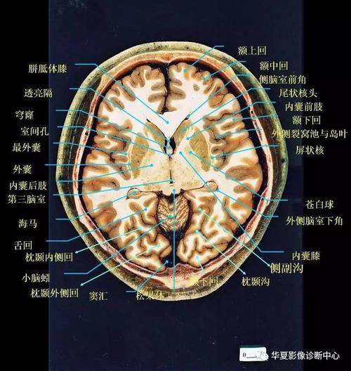 大脑各叶分界标志(三沟五叶)