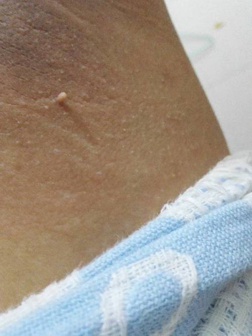 腋下长很多这种小肉瘤瘤,求解