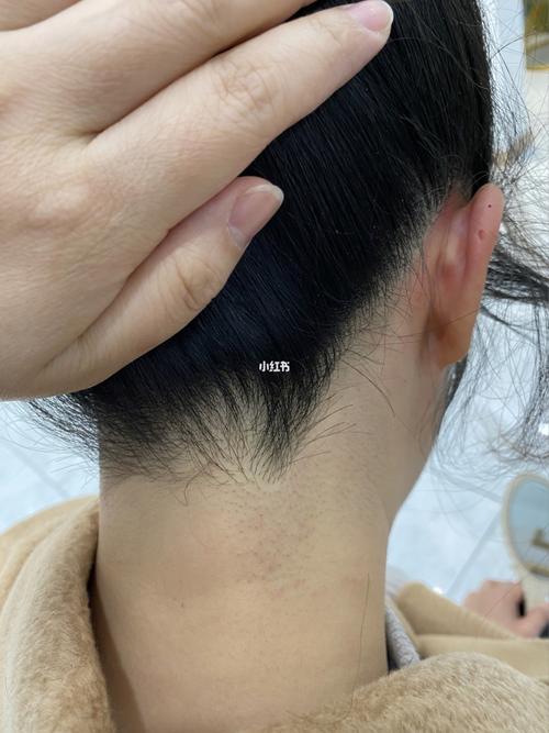 记录激光脱毛后发际线鬓角记录(1)_激光脱毛_脱毛_发际线_毛孔粗大