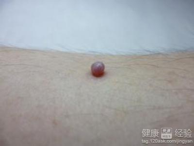 如果对生活影响不大的话可以正文  步骤/方法: 1点血管瘤形成的原因有