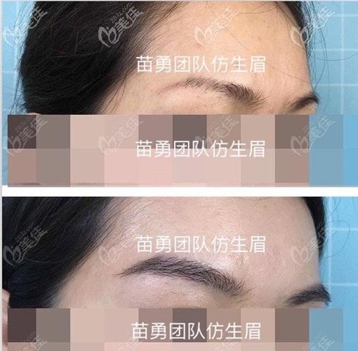 广州荔医苗勇医生的植眉案例效果图含疤痕男女士眉毛种植的对比照片