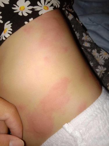 小孩过敏身上大片红疙瘩怎么办?