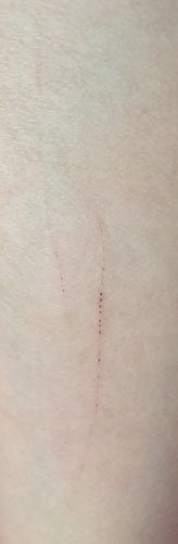 这是给狗咬的伤口吗,不知道是不是给狗牙齿刮到,当时没啥知觉,有破