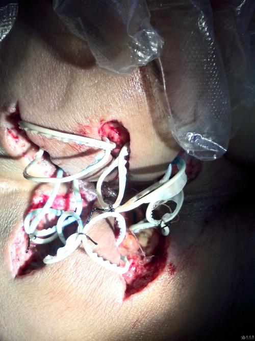 马蹄瘘术前术后照片